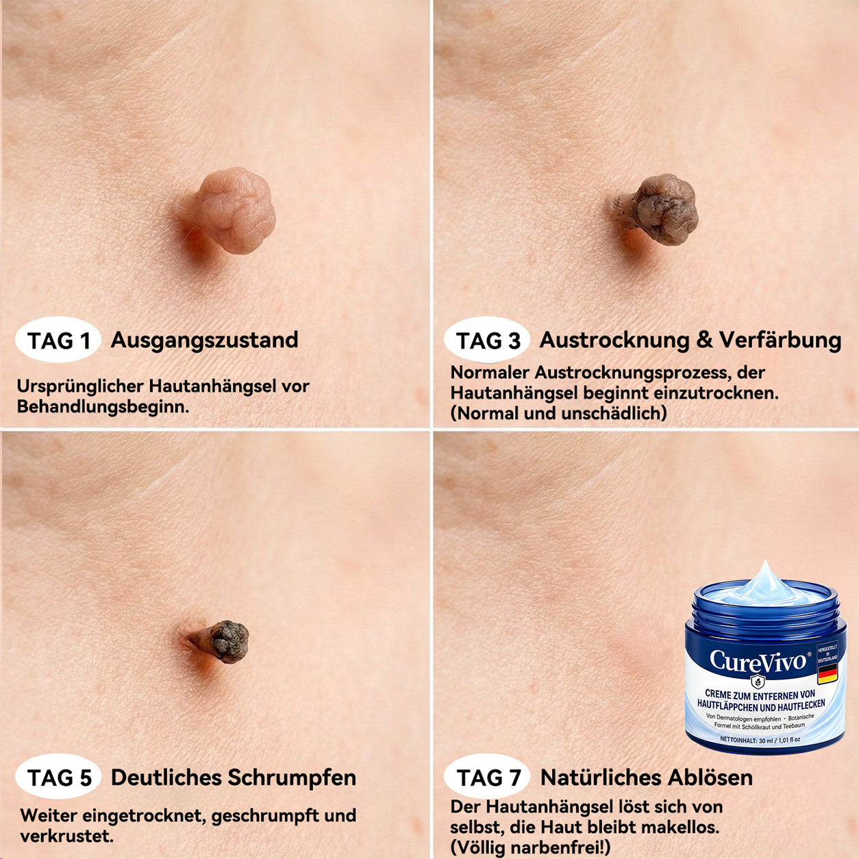 🛡️🛡️CureVivo® 💥💥7-Tage Hautanhängsel- & Flecken-Entfernungscreme (schmerzfreie Formel – ohne Narben)