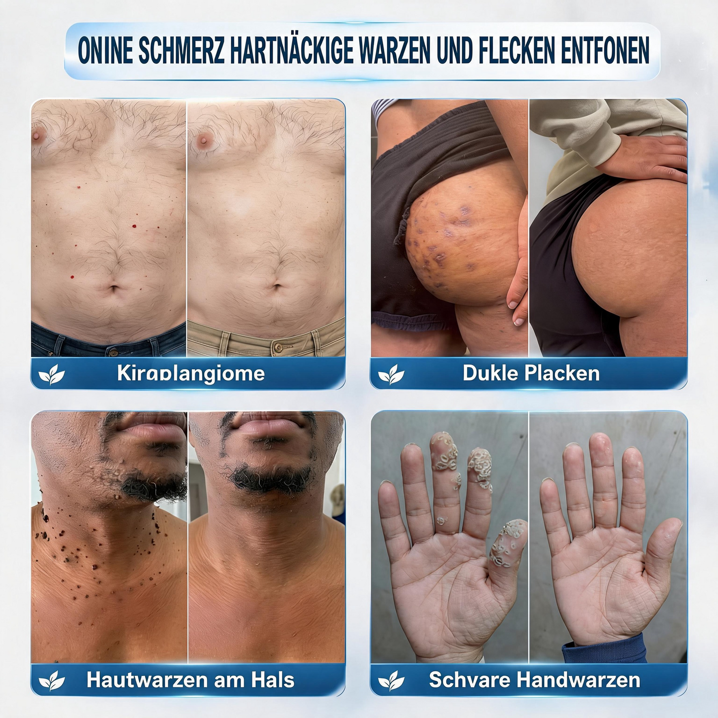 🛡️🛡️CureVivo® 💥💥7-Tage Hautanhängsel- & Flecken-Entfernungscreme (schmerzfreie Formel – ohne Narben)