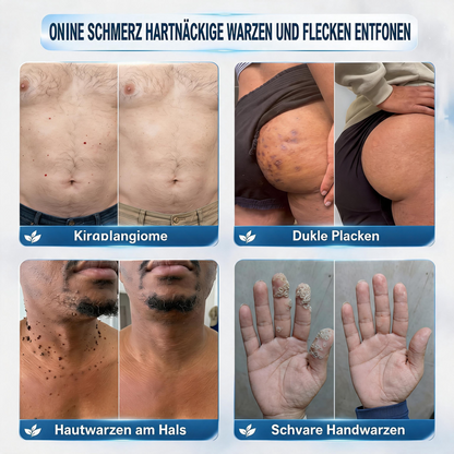 🛡️🛡️CureVivo® 💥💥7-Tage Hautanhängsel- & Flecken-Entfernungscreme (schmerzfreie Formel – ohne Narben)